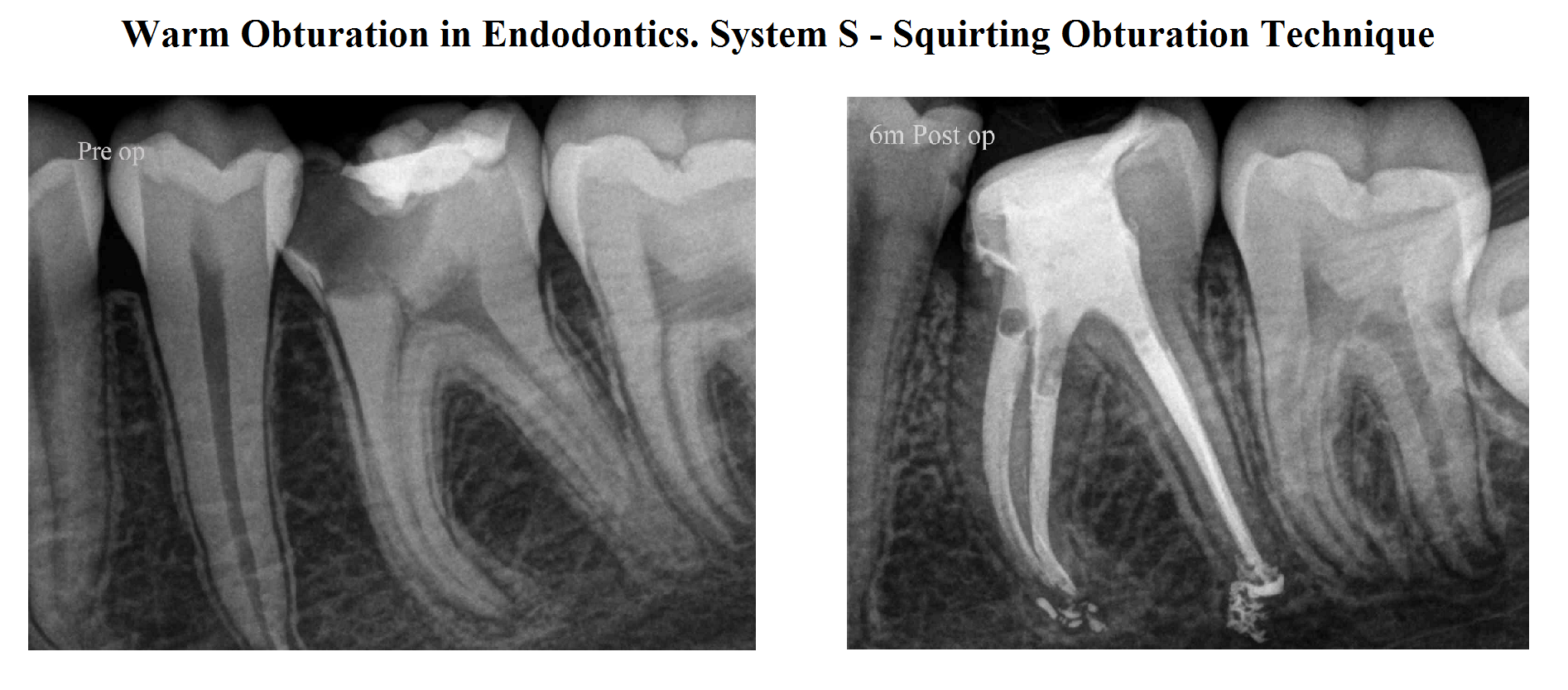 Endodontic case visual